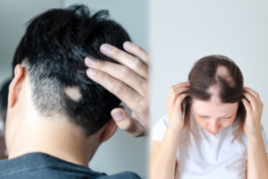 ผมร่วง ปก