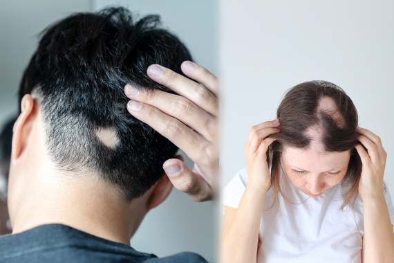 ผมร่วง ปก