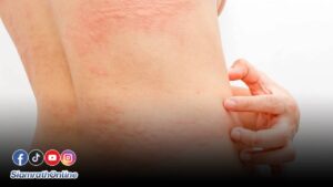 ผื่นคัน